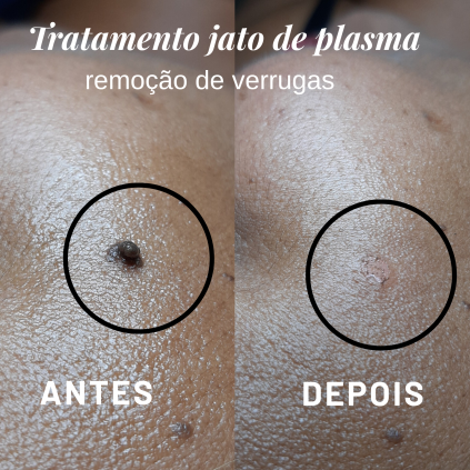 Remoção de verrugas 